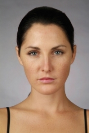 Botox (after treatment) Gloucestershire